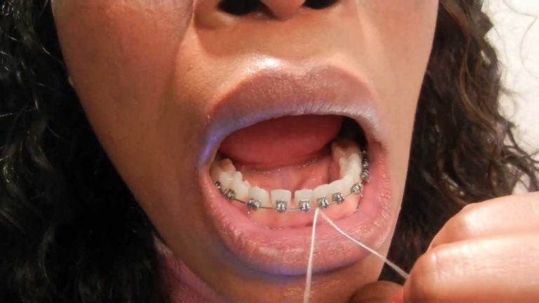 Cracked Tooth Or Craze Lines From Braces