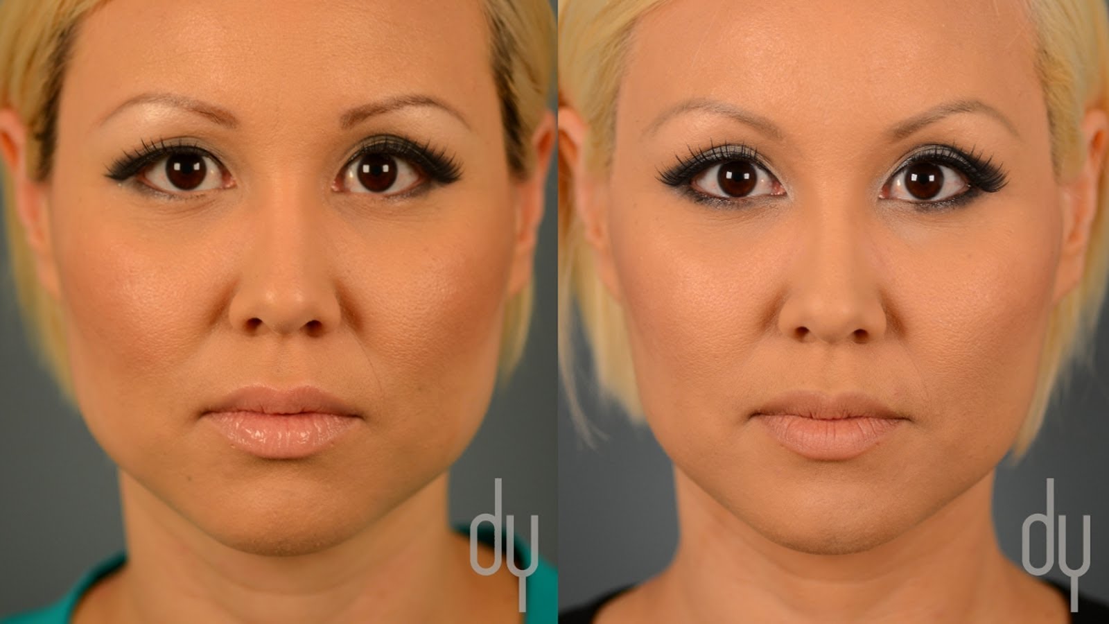 Процедура нефертити для лица фото до и после