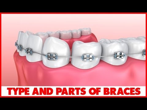 Types and Parts of Dental Braces – Dentists Columbus OH