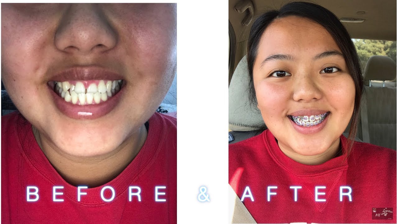 I GOT ADULT BRACES FOR MY UNDERBITE WITHOUT SURGERY 2018! Dentists