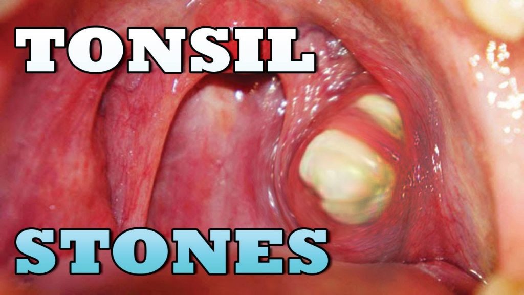 Removing Tonsil Stones With Toothpick