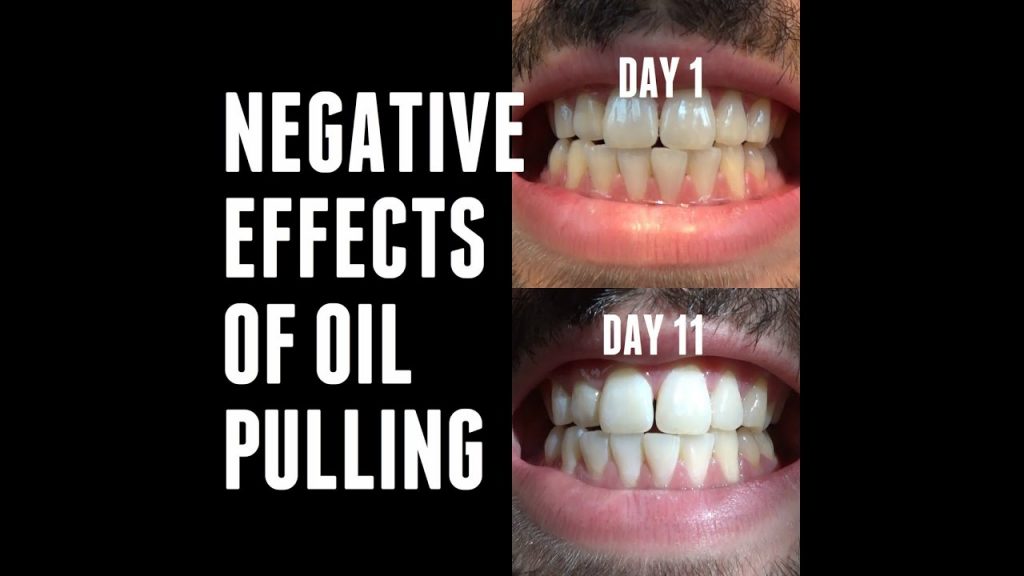 OIL PULLING EXPERIMENTS – Negative/Side Effects | Day 11 – Dentists